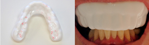 スポーツマウスピースは歯科医院で歯科医師が調整することが大事・東京都港区麻布十番